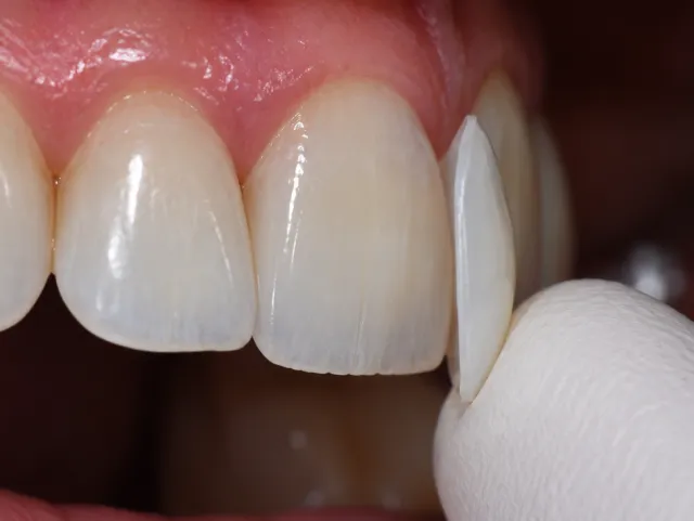 Mano con guante acercando una carilla de porcelana a un diente frontal para probarla